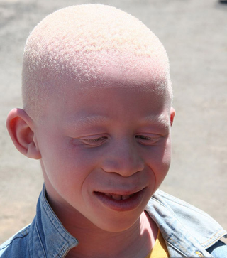 Illustration for article titled Decapitan a una niña de cinco años por sus presuntas propiedades mágicas: el terror de ser albino en algunos países de África